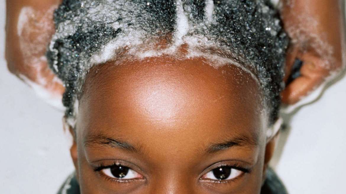 Anomalies capillaires : Ces maladies qui affectent les cheveux