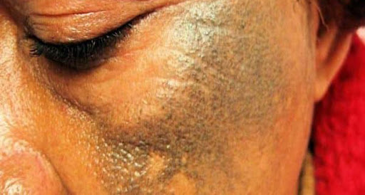 Dépigmentation de la peau : pourquoi les femmes se « tcha »