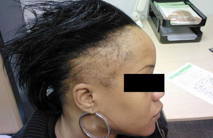 Chute totale de cheveux : quand 84% de femmes sont touchées par l’Alopécie (femme chauve)