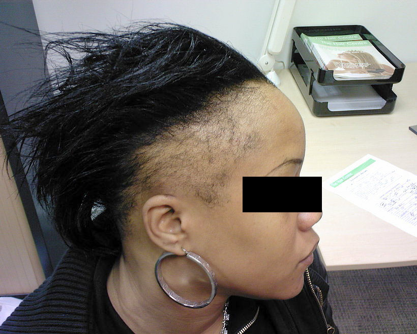 Chute totale de cheveux : quand 84% de femmes sont touchées par l’Alopécie (femme chauve)