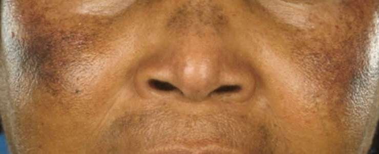Dépigmentation de la peau : Pourquoi certains hommes le font ?