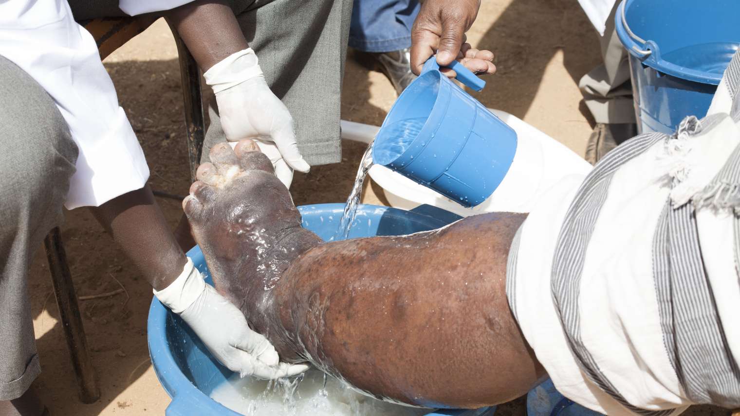 <strong>Que savoir sur l’éléphantiasis ou pied d’éléphant</strong>