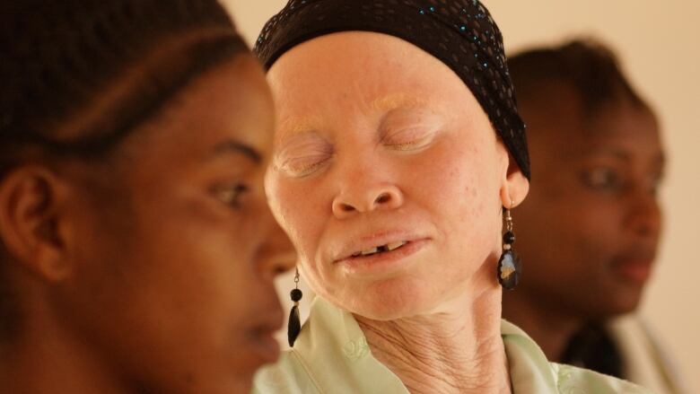 Albinisme : vivre avec la peur au ventre