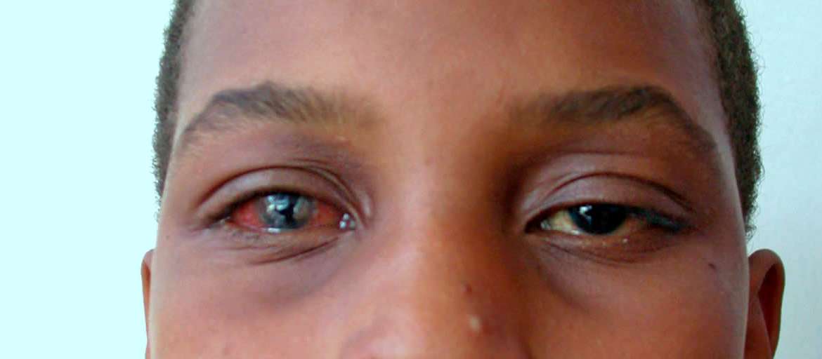 La conjonctivite, une maladie des yeux qui est très fréquente