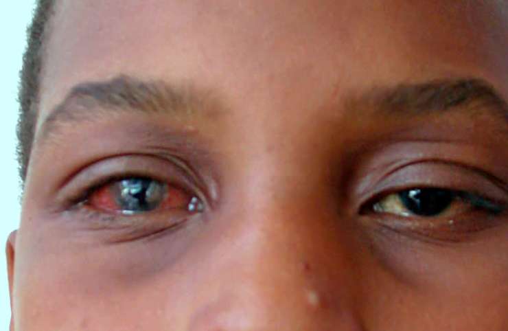 La conjonctivite, une maladie des yeux qui est très fréquente