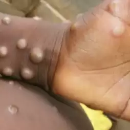 L’épidémie mpox: Des inquiétudes malgré le discours rassurant