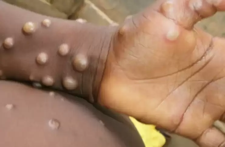 L’épidémie mpox: Des inquiétudes malgré le discours rassurant