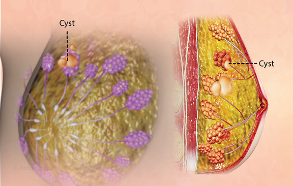 Kyste mammaire: Bénin et rarement cancéreux